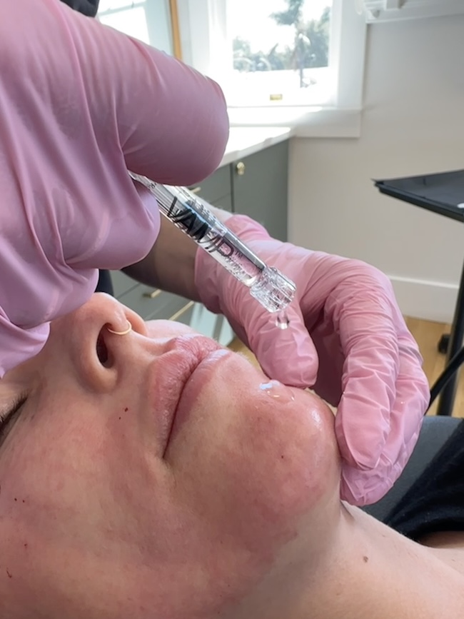 vamp being dripped from syringe onto skin after procedure